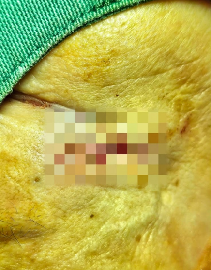 부산상처봉합 - 수술전