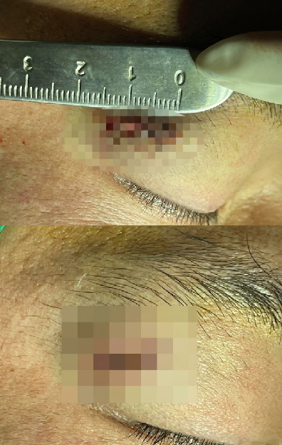 부산상처봉합 - 하라라성형외과