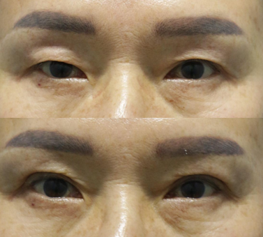 부산상안검수술 전후