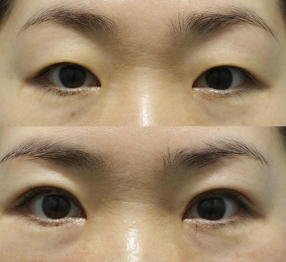 부산자연유착쌍꺼풀 수술전후