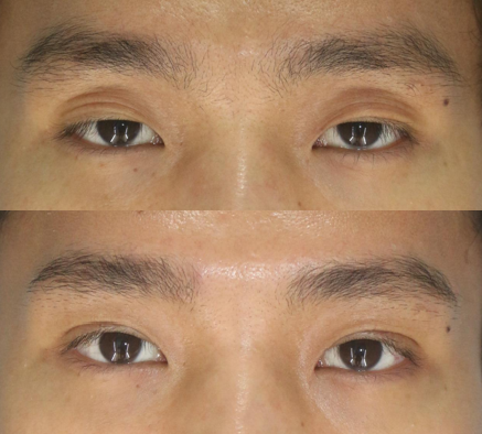 부산안검하수교정전후