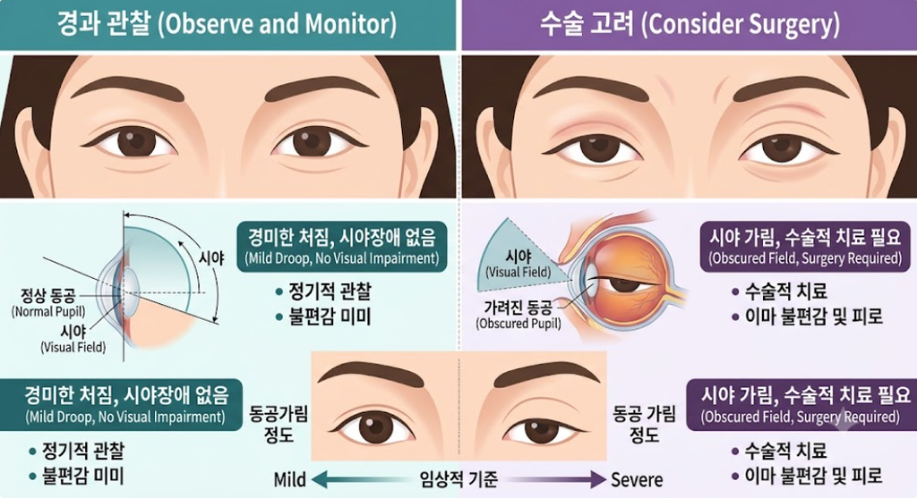 [이미지: 경과 관찰 중인 경미한 안검하수와 수술이 필요한 정도의 안검하수를 나란히 표시한 비교 도해]
ALT: 시야를 가리지 않는 경미한 처짐과 시야를 가리는 처짐을 눈금선으로 비교한 그림
눈동자 위쪽 경계를 가리는 정도가 관찰과 수술을 가르는 실질적 기준입니다.